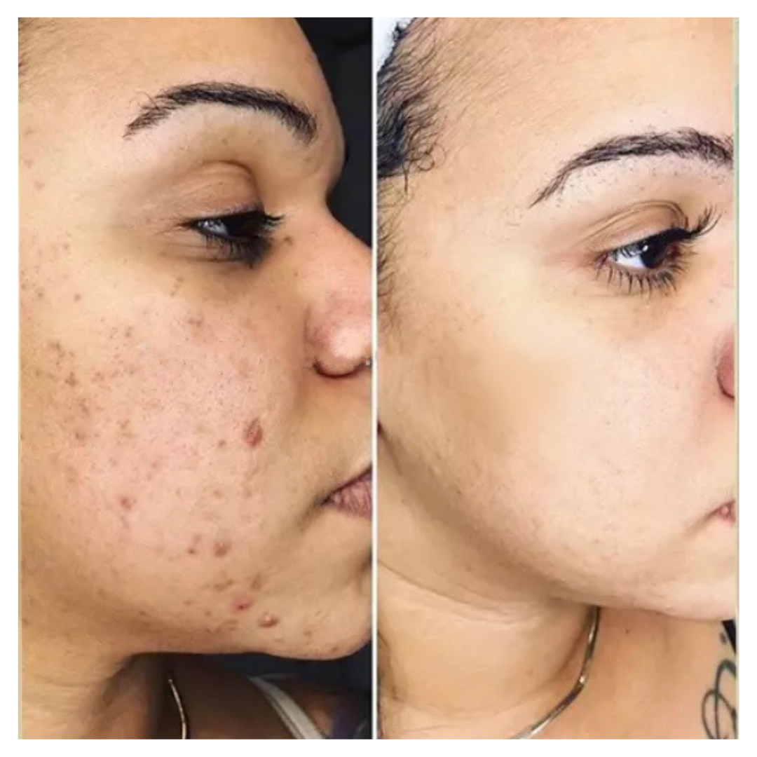 Intense Discoloration Treatment