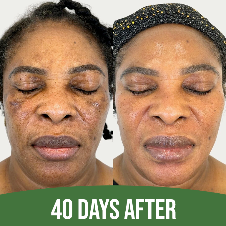 Intense Discoloration Treatment