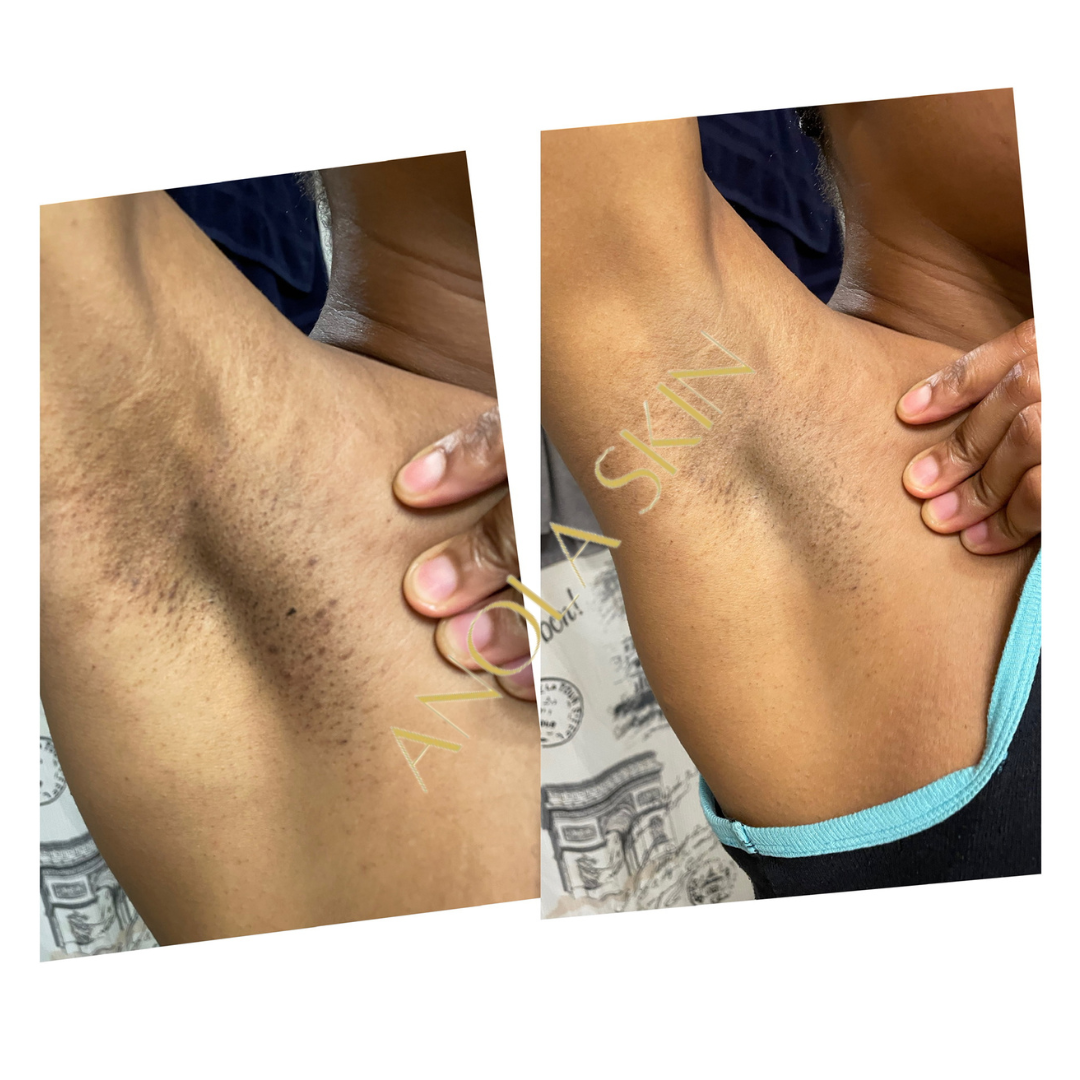 Intense Discoloration Treatment