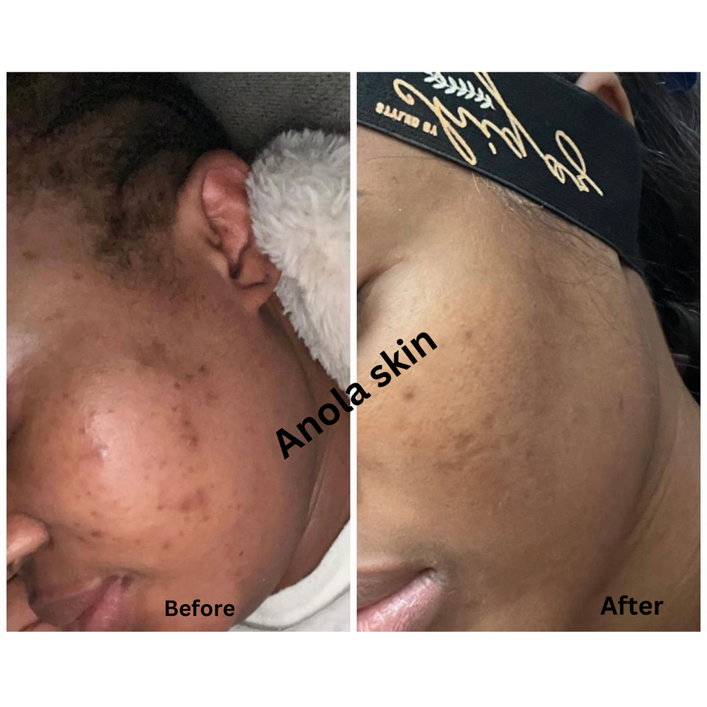Intense Discoloration Treatment